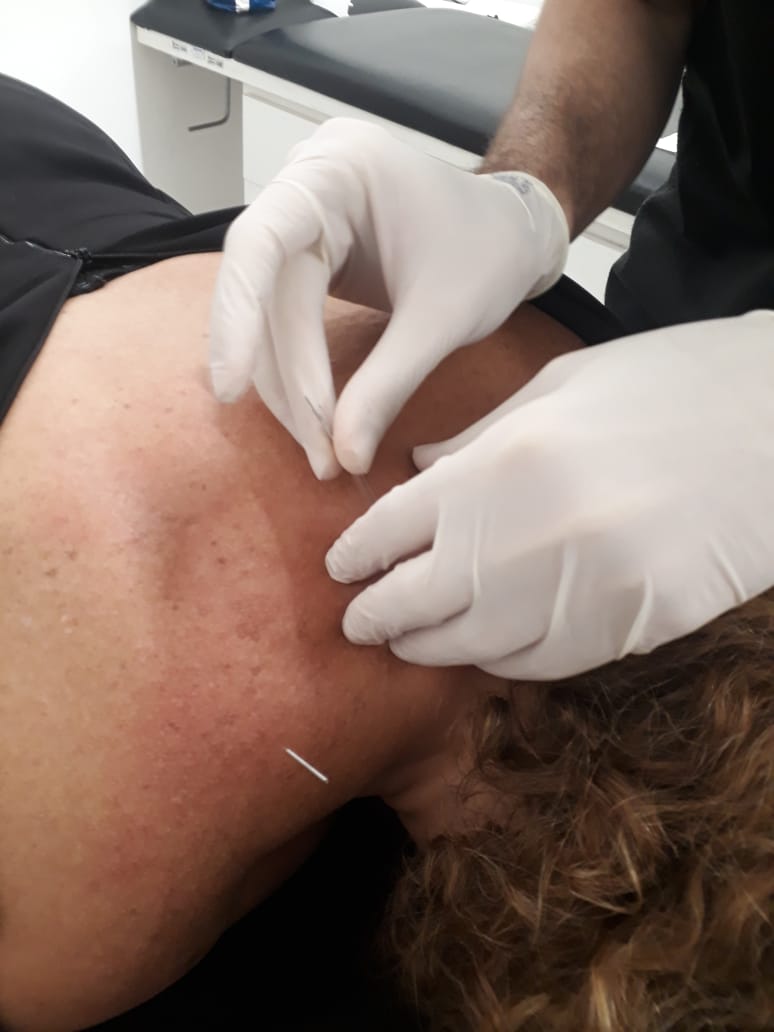 Dry Needling